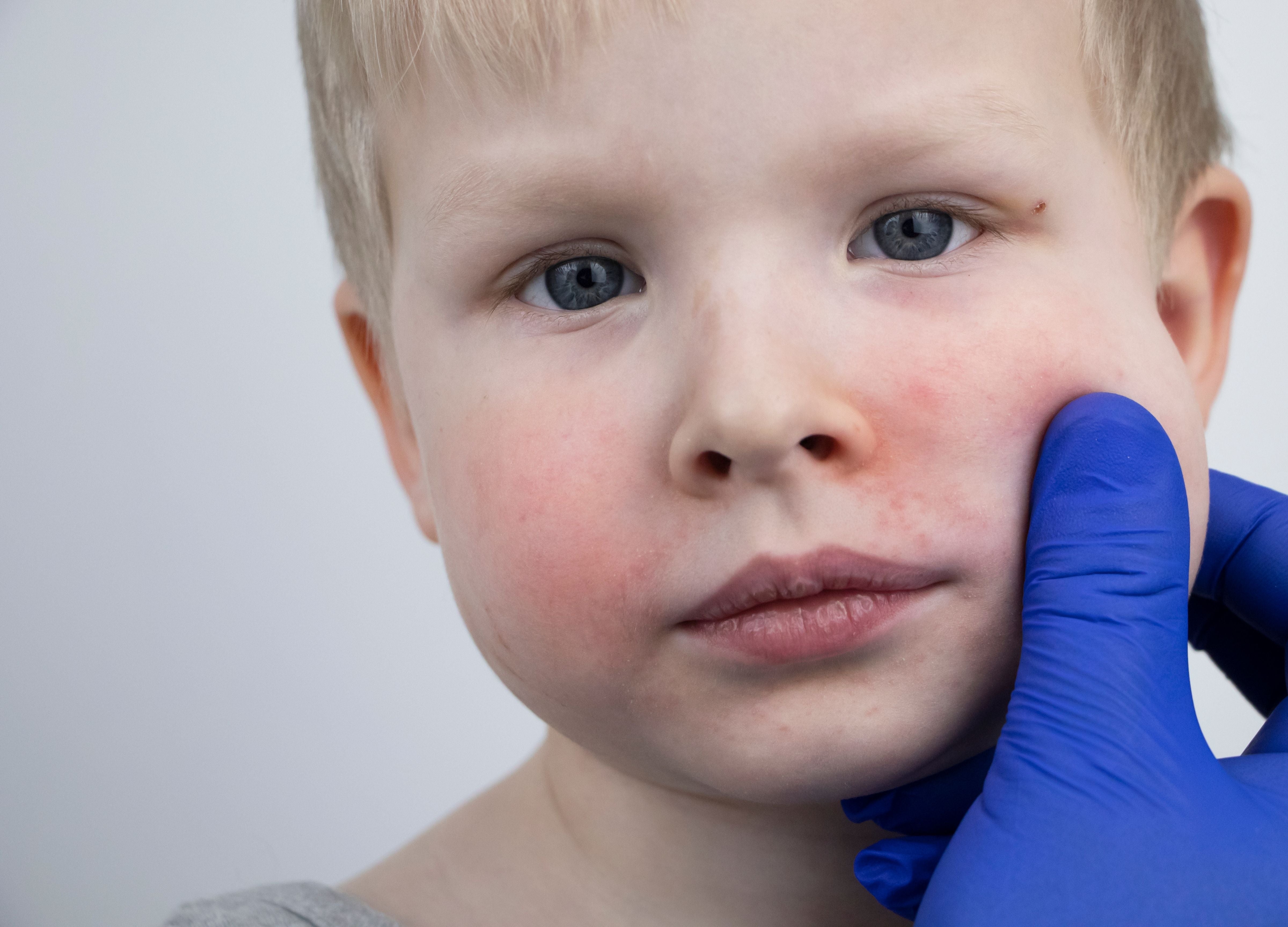 Eczema Oil (Child)