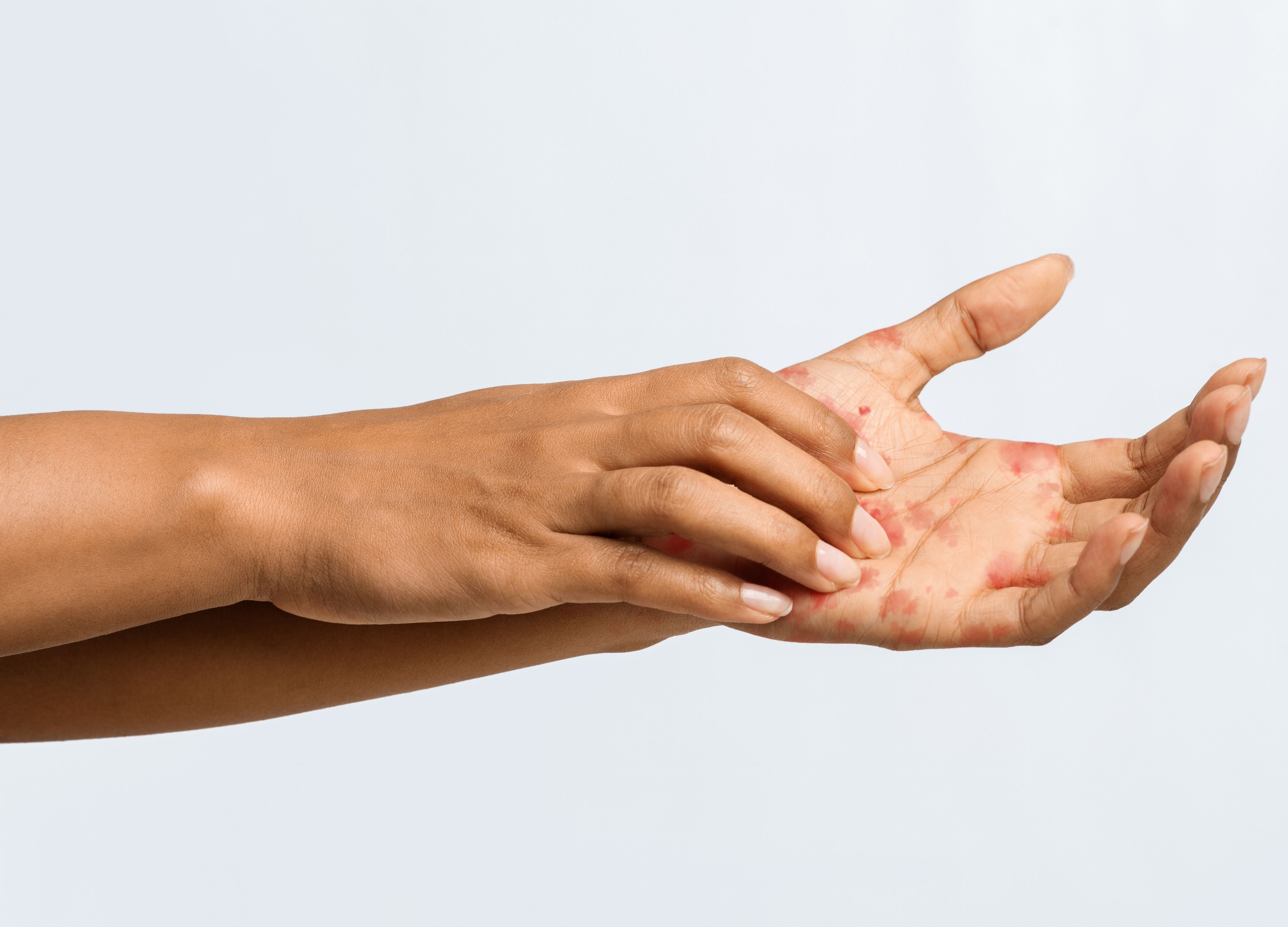 Eczema Butter (Child)